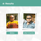 Keshpallav Hair Oil for Stage 1 & 2 Hair Loss